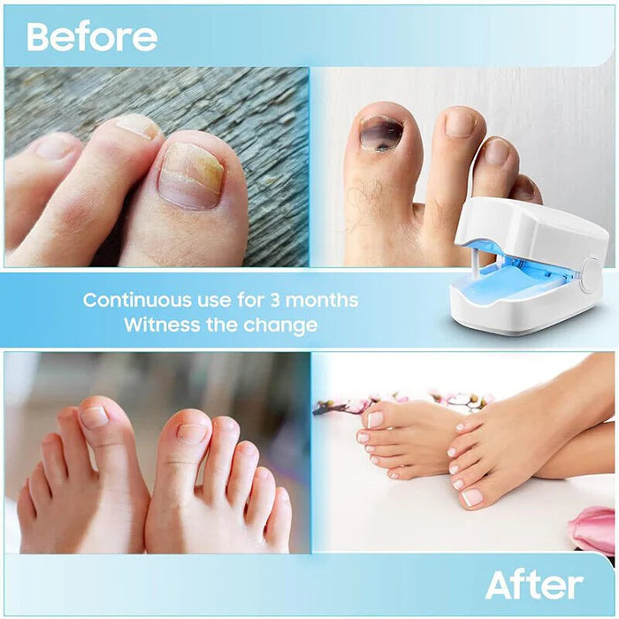 Nail Fungus Cleaning Laser Device - Expert Revolutionary High-Efficiency Light Therapy Device For Toenail Diseases